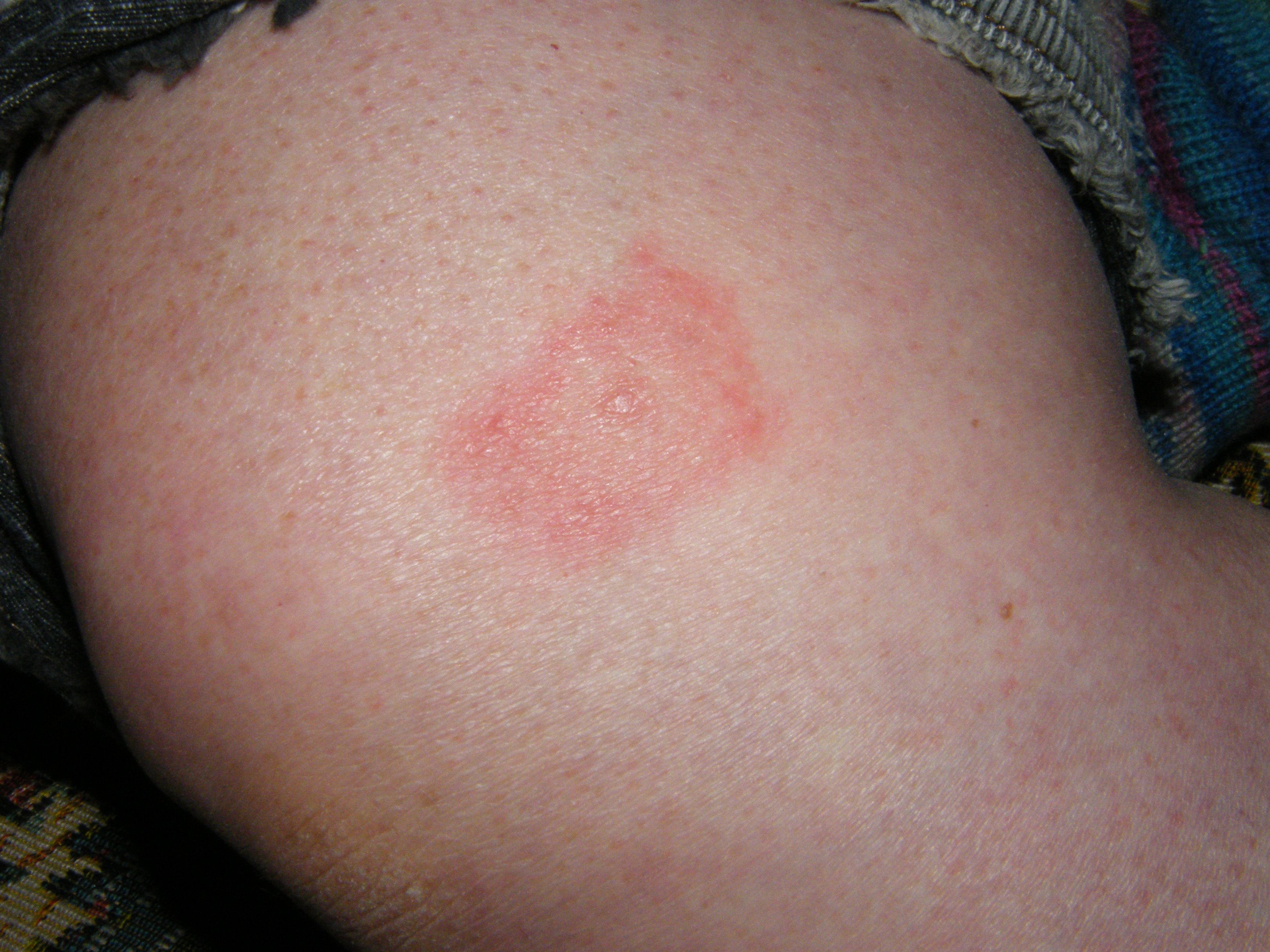 final-report-on-lyme-like-illness-released-australian-medical-association