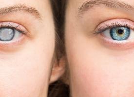 two ladies, one with cataracts, one without