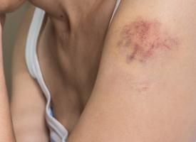 women with bruised arm