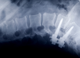 Spinal screws