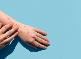 person with monkeypox