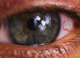 eye experiencing allergic reaction