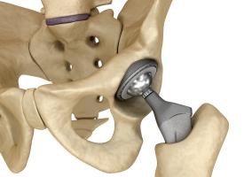 hip device 