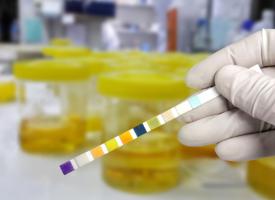 Image of basic urine test to diagnose UTI