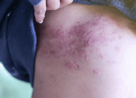 Shingles 