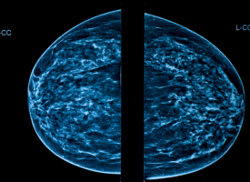 Mammogram
