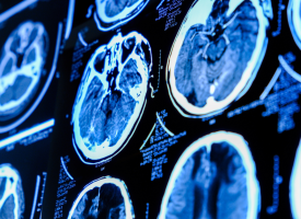 Scan of brain